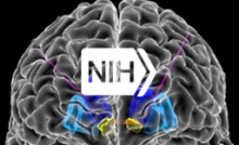 Illustration of human brain with electrodes.